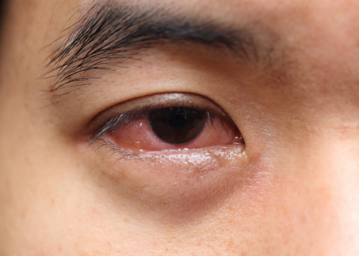حساسية العين اعراض أعراض مشاكل