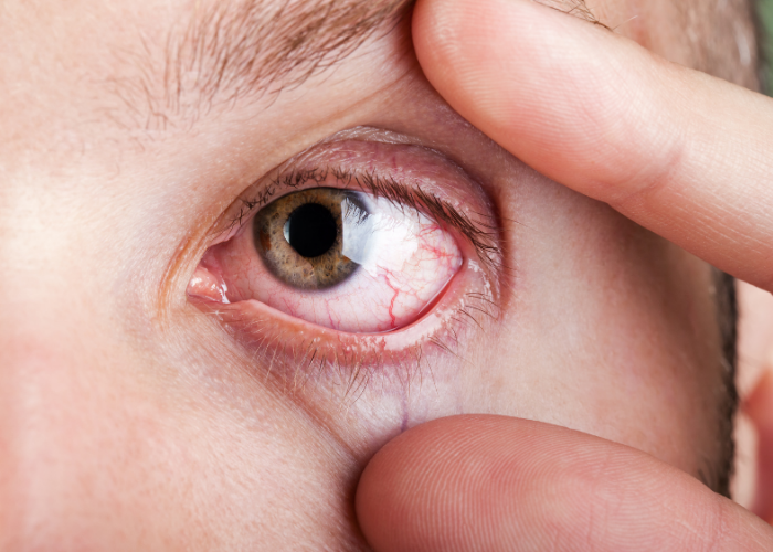 علاج جفاف العين بالطب النبوي