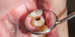 هل تسوس الأسنان يسبب السرطان
