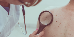 هل سرطان الجلد معدي؟ | ما هي المناطق التي ينتشر بها سرطان الجلد؟